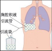 大家对于恶性胸水了解多少？