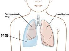 胸水积聚在胸膜腔中能不能被人体吸收？