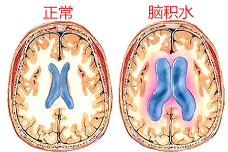 脑子里不知道什么原因导致的积水有哪些症状？