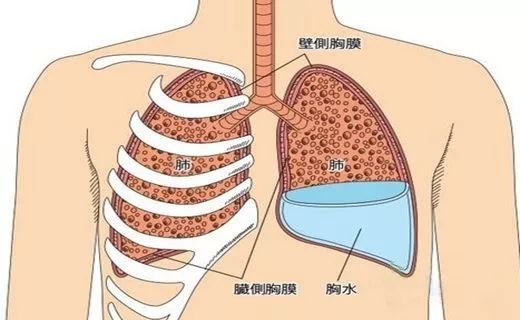 不明原因性肺积水能治好吗？淋滞疏通丸