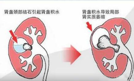 不明原因肾积水一直反复应该怎么办？淋滞疏通丸