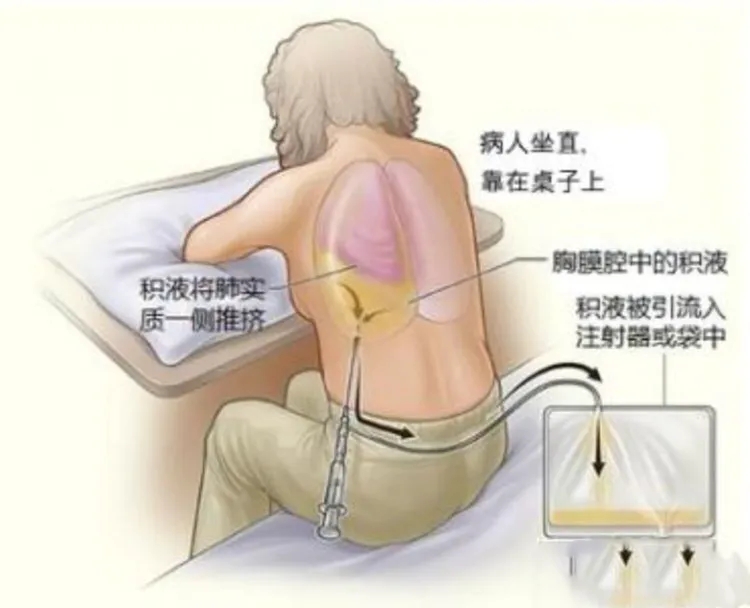 胸水穿刺抽水分几步完成？淋滞疏通丸
