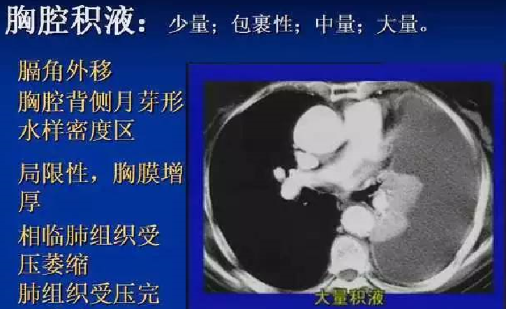 胸水应该怎么治疗及预防？淋滞疏通丸