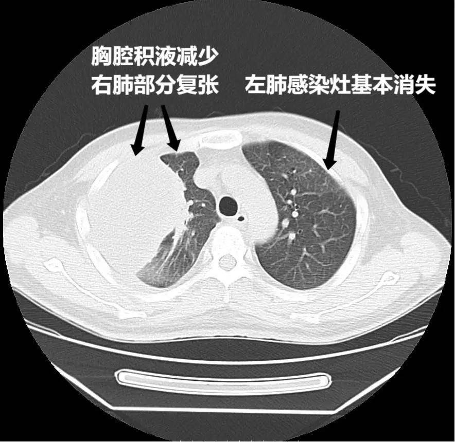 结核导致的胸水怎么治疗及预防？淋滞疏通丸